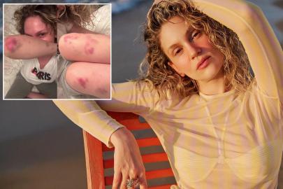 Farah Zeynep Abdullah'ın vücudundaki morluklar korkuttu